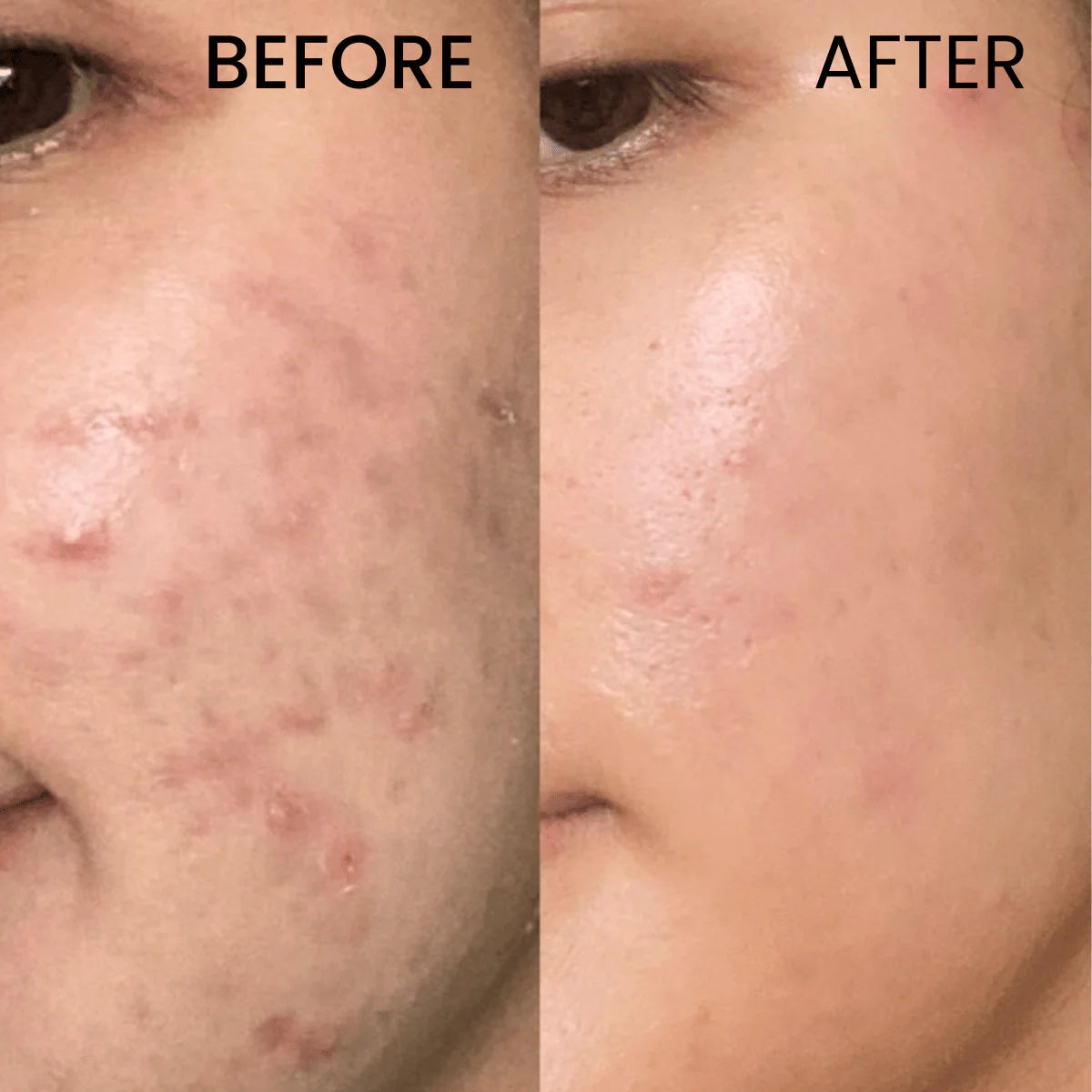 Buy 1 Acne Control Cleanser & Get 1 Daily Moisturizing Lotion Free