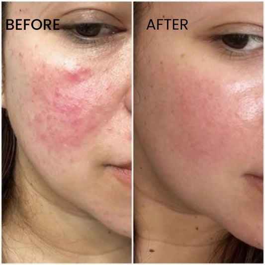 Buy 1 Acne Control Cleanser & Get 1 Daily Moisturizing Lotion Free