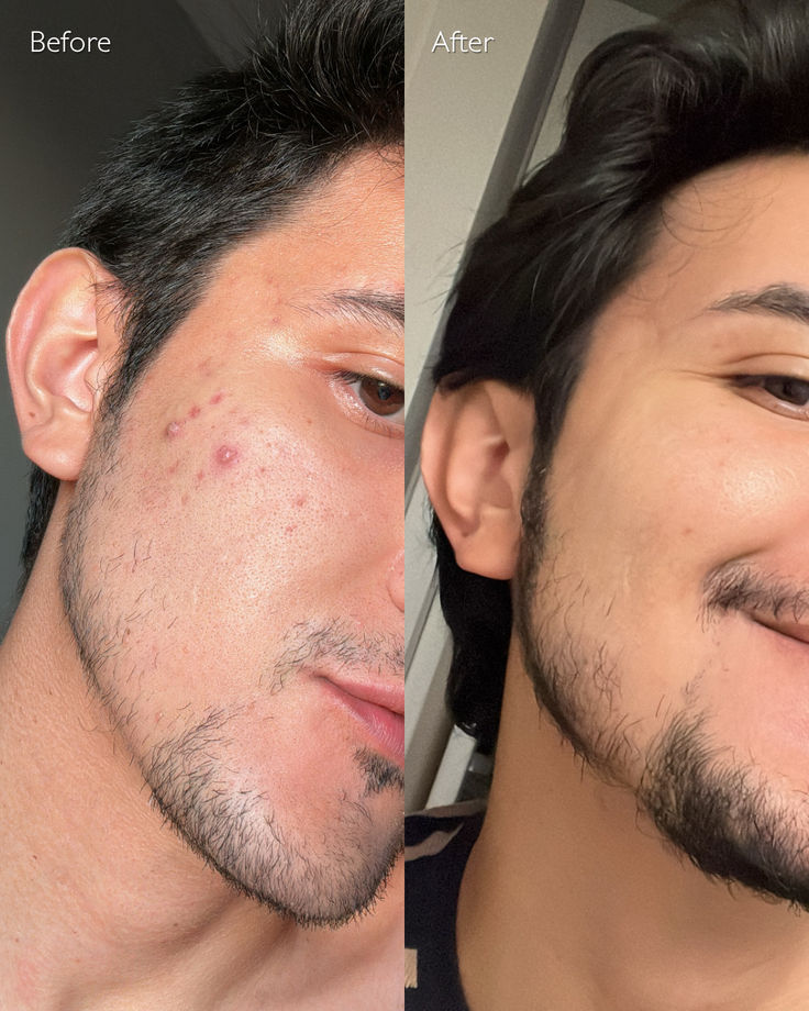 Buy 1 Acne Control Cleanser & Get 1 SA Lotion For Rough & Bumpy Skin Free