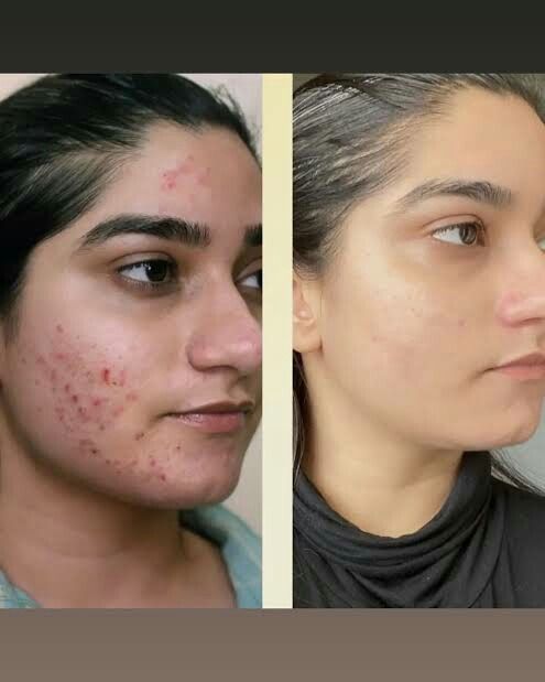 Buy 1 Acne Control Cleanser & Get 1 Daily Moisturizing Lotion Free